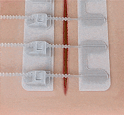 ZipStitch Medical Skin Closure Kit 18cm